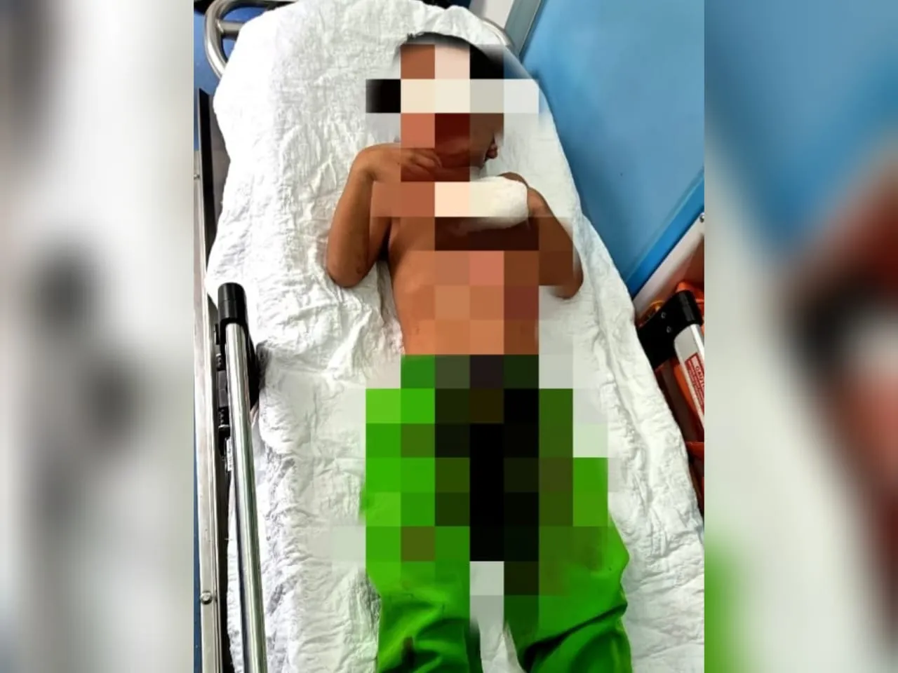 Budak 5 Tahun Jadi Mangsa Mercun di Kedah, Putus Jari Telunjuk