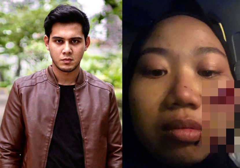 Ditumbuk Sampai Lebam oleh Hafidz Roshdi, Bekas Isteri Alami 10 Jahitan di Wajah