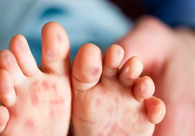 Wabak HFMD Naik 266 Peratus, Selangor Catat Kes Tertinggi di Malaysia
