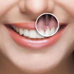 kelebihan dan kekurangan implan gigi